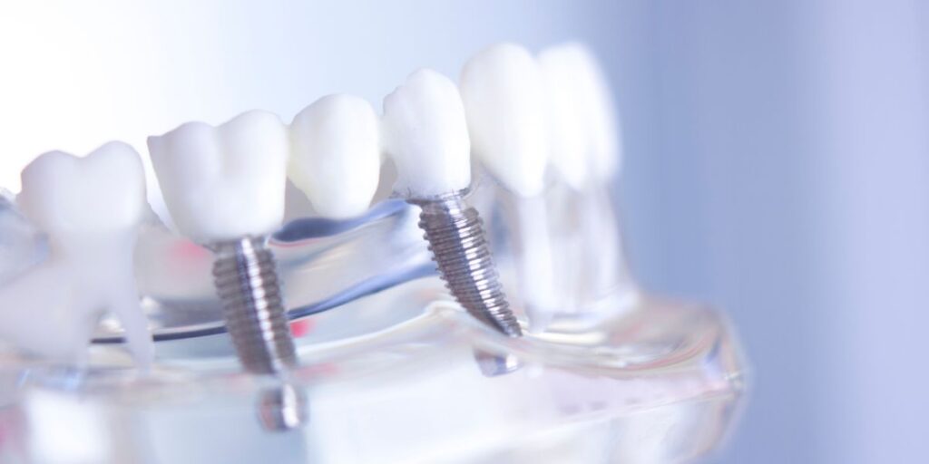 Dental Implants