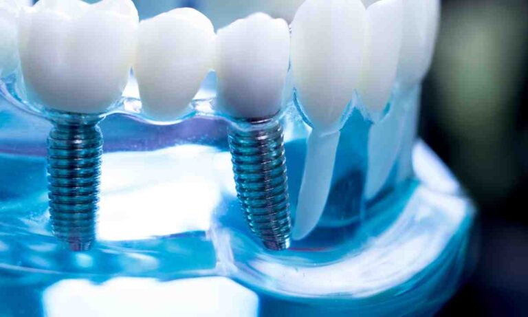 Unlocking the Best Age for Dental Implants