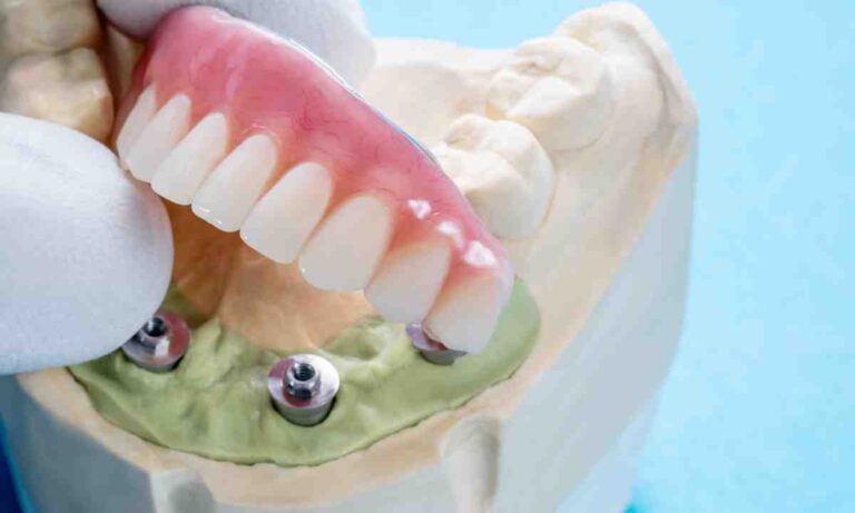 Dental Implant Store Online Advice: Understanding the Failure Rate for Dental Implants